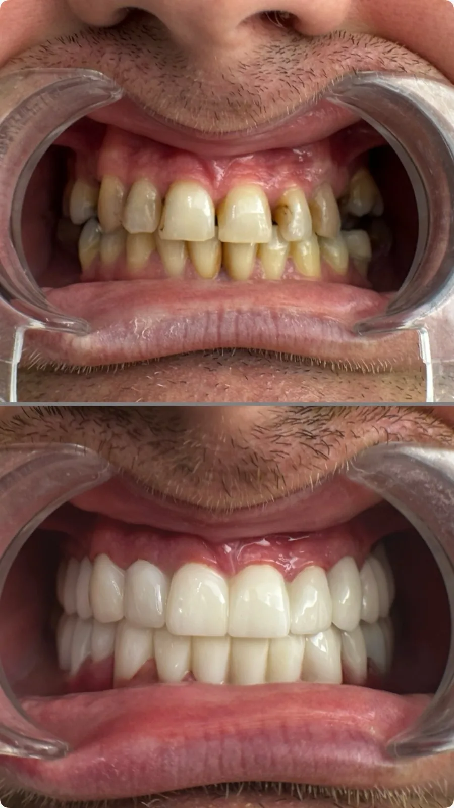 Vorher-Nachher Veneers und Kronen, Zahnklinik Kuşadası